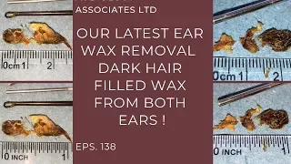 DARK HAIRY EAR WAX REMOVAL - EP 138