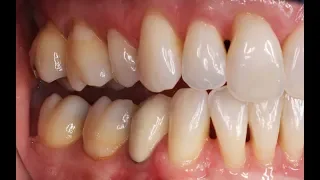 What Are Those Black Triangles Between the Teeth?