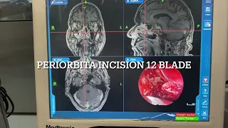 Transnasal Endoscopic Orbital decompression by Navigation- Dr Manish Prakash-Mayom Hospital Gurgaon