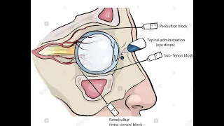 Peribulbar and retrobulbar Block  for eye surgery