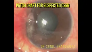 OSSN surgical management