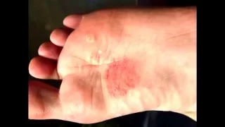 Чем вылечить грибок ноги стопы ногтей пальцев