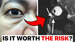 Why I Stopped Filling Tear Troughs... | Surgeon Reacts