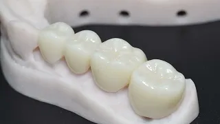 Types of Dental Crowns and Materials - Gold, Porcelain, Lithium Disilicate, & Zirconia
