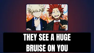 They see a huge bruise on you - Kiribaku x listener