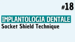 Implantologia Dentale - Socket Shield Technique