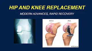 Modern Advances in Hip and Knee Replacement and Rapid Recovery