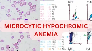 MICROCYTIC HYPOCHROMIC ANEAMIA : CASE BASED DISCUSSION | IDA | THALESSEMIA | AOCD| SIDERBLASTIC