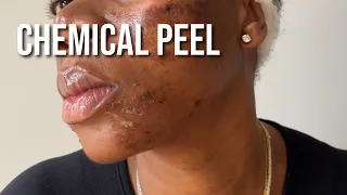 PCA Chemical Peel on Black Skin for Hyperpigmentation and Texture