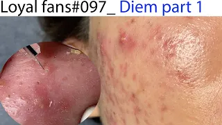 Acne Treatment Huong Da Nang# 097 |  Loyal fans _  Part 1