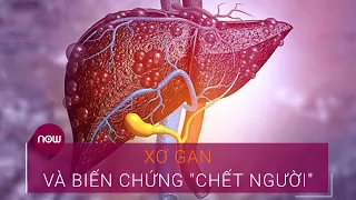 Xơ gan và những biến chứng "chết người" | VTC Now