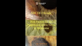 ABCDEF Guide. Mnemonic Rule for Risk Factors in the Progression of Iris Nevus to Melanoma.