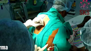 THORACIC PARAVERTEBRAL BLOCK/PNS GUIDED/THORACIC BLOCKS/PAIN MANAGEMENT/TPVB