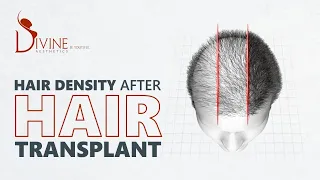 Hair Density After Hair Transplant