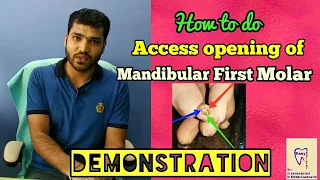 Mandibular molar Access opening in hindi ( English Subtitle)