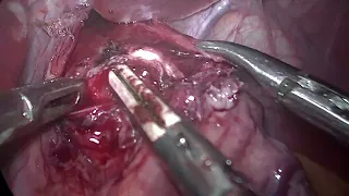 Mucosal Perforation in Heller’s Cardiomyotomy