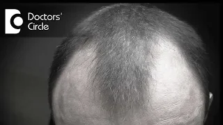 Can minoxidil be helpful in treating bald patches in young men? - Dr. Rasya Dixit