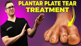 Plantar Plate Tear Treatment [Fix a Torn Plantar Plate]