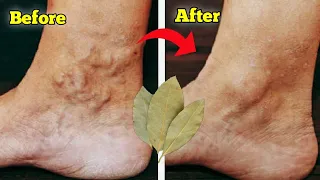 Say goodbye👍 to varicose veins and joint pain with only bay leaf/ which is 100% effective !!