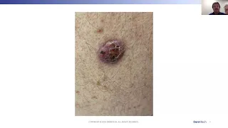 May Ask the Expert - Everything Skin Cancer and Melanoma