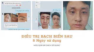 Điều trị bạch biến cùng HEMA CARE sau 8 ngày sử dụng (KH THỊNH TRẦN) | Điều trị bạch biến HemaCare