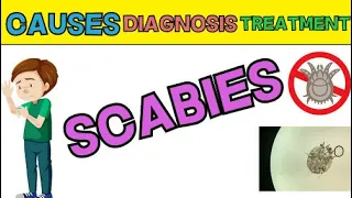 Scabies explained in 3 Minutes- Cause, Symptoms, Treatment - Crusted Scabies