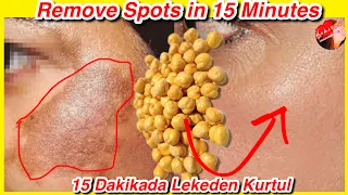 100% It Works! Wipe Dark Face Spots Off With Chickpea Just After 15 Minutes - Natural Skin Care