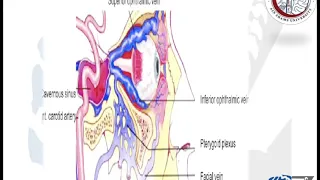 Vascular (20) : Carotid-Cavernous Fistula