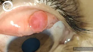 palpebral conjunctival pyogenic granuloma CC91