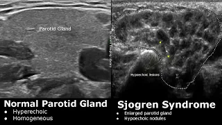 Salivary Glands Ultrasound Normal Vs Abnormal Images | Parotid, Submandibular & Sublingual Gland USG