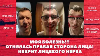 МОЯ БОЛЕЗНЬ!!! ОТНЯЛАСЬ ПРАВАЯ СТОРОНА ЛИЦА! НЕВРИТ ЛИЦЕВОГО НЕРВА