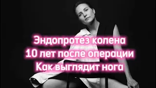 Как выглядит нога , спустя 10 лет после операции по эндопротезированию