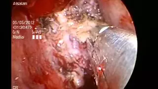 Endoscopic Orbital Surgery