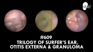 609 - Trilogy of Surfer's Ear, Otitis Externa & Granuloma