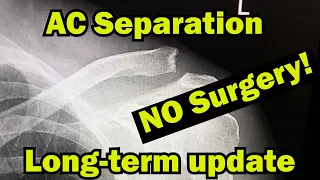 AC Separation long term update no surgery! Mountain bike MTB