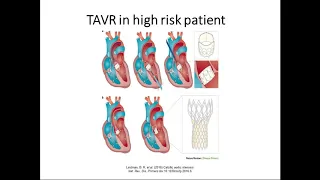 Heart Valve Disease Webinar