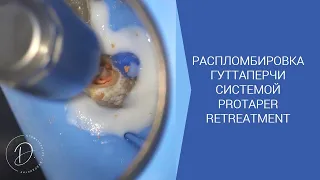 Распломбировка гуттаперчи системой protaper retreatment и soco