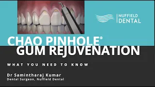 CHAO Pinhole Gum Rejuvenation - What You Need To Know with Dr Samintharaj Kumar (FULL VERSION)