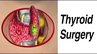 Thyroid Surgery to Remove Nodule Suspicious for Cancer