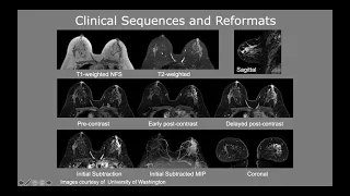 New update : Breast MRI