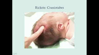 Rickets - CRASH! Medical Review Series