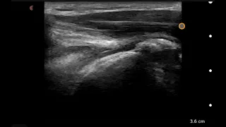 Rotator Cuff LAX: Ultrasound Image Interpretation