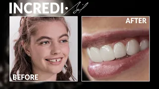 Incredibil Veneers - Elevated Smile Design