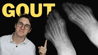 Gout X-ray features