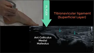 Deltoid Ligament Ultrasound 2023