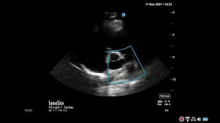 How to...Measure Pulmonary Artery Diameter