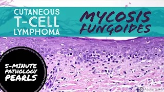 Mycosis Fungoides (Cutaneous T-Cell Lymphoma): 5-Minute Pathology Pearls