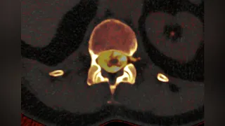 Photon-Counting Computed Tomography of a Cerebrospinal Fluid (CSF) Venous Fistula