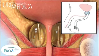 ProACT Therapy Procedure Animation