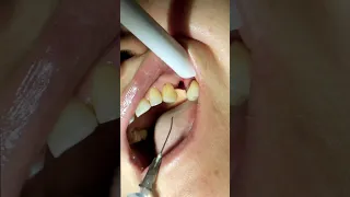 Installation of the shaper in the tooth implant